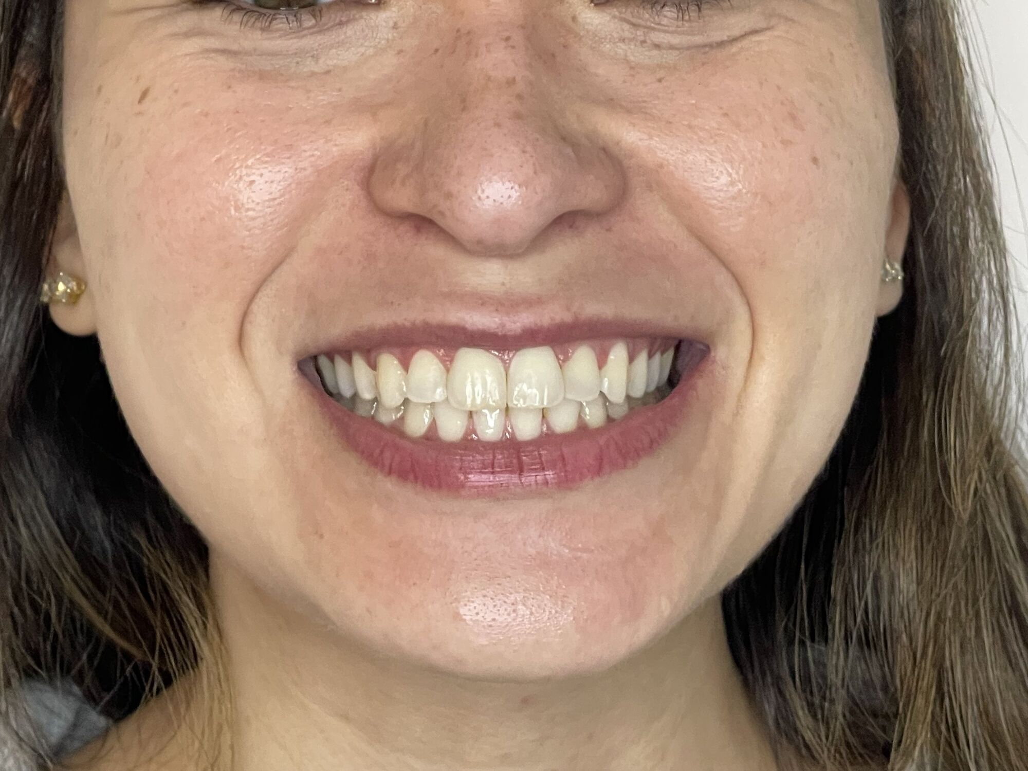 Sorriso de paciente antes do clareamento