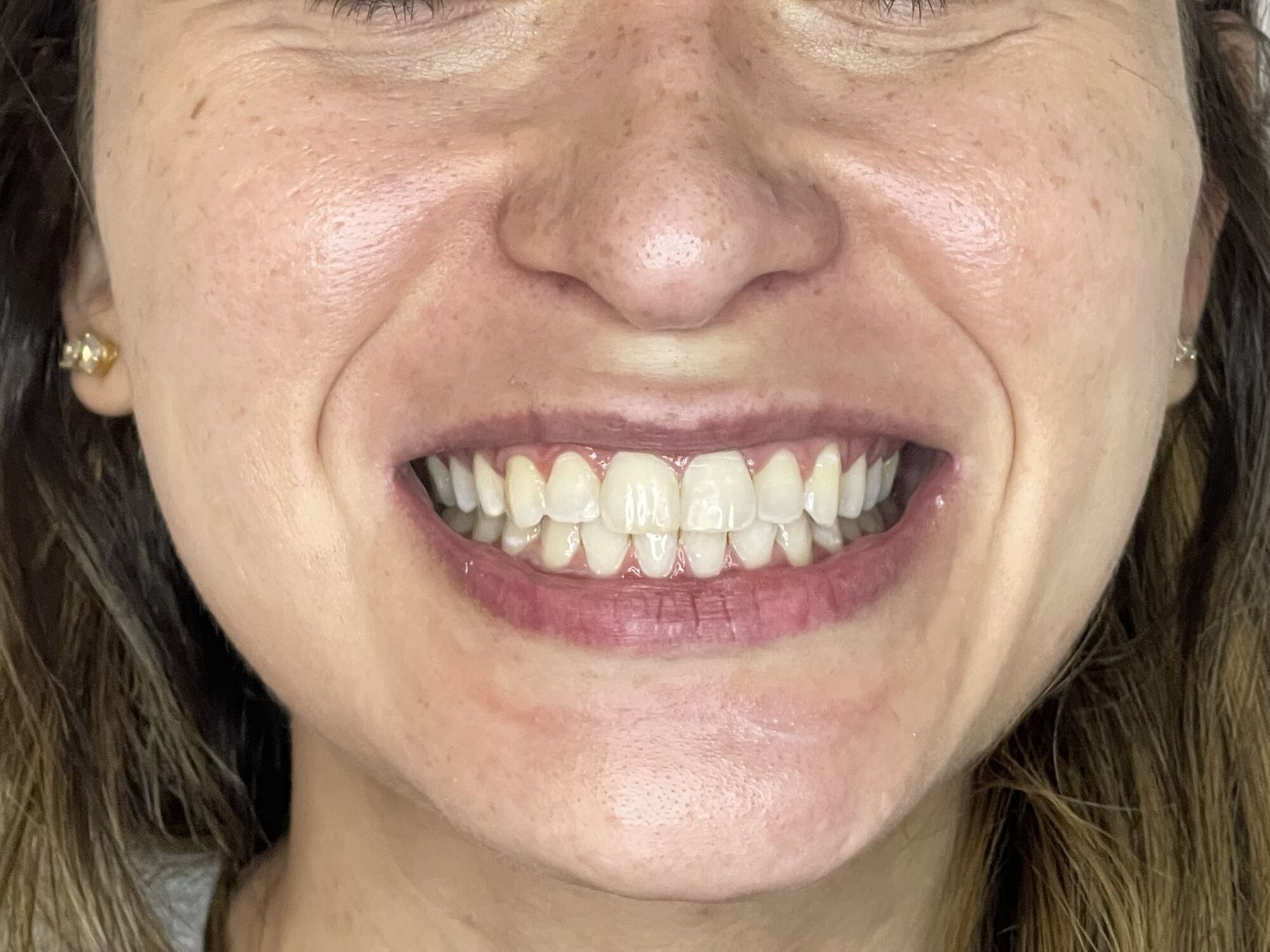 Sorriso de paciente depois do clareamento