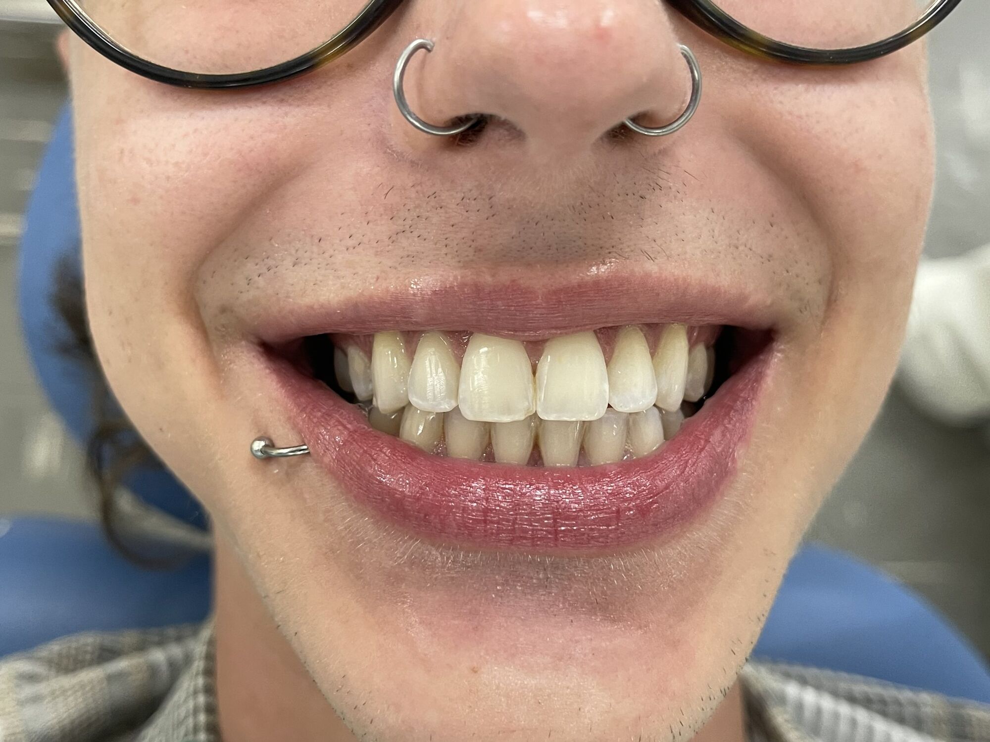 Sorriso de paciente antes do clareamento