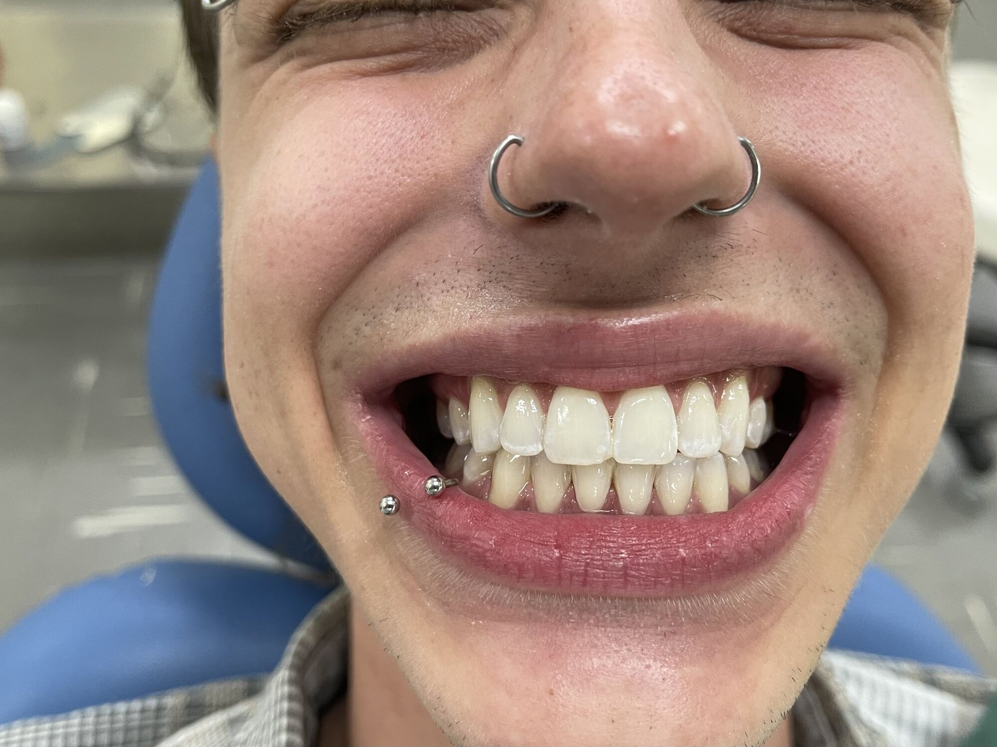 Sorriso de paciente depois do clareamento